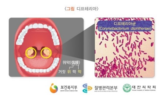 급성 전염병 '디프테리아', 베트남서 어린이 3명 숨져