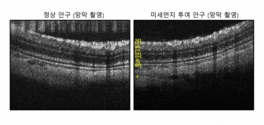 “미세먼지=안과 질환 원인, 과학적 입증”