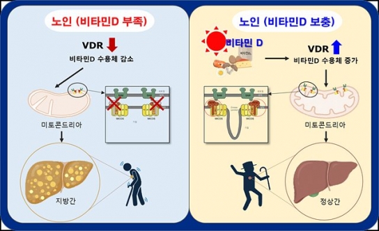 비타민 D, 노인성 지방간 예방의 새로운 희망